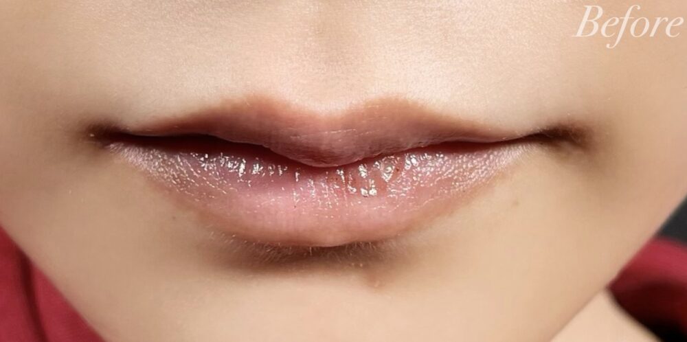 「口角をあげてアヒル口にしたい☆」現役美容外科医が唇ヒアルロン酸を解説！