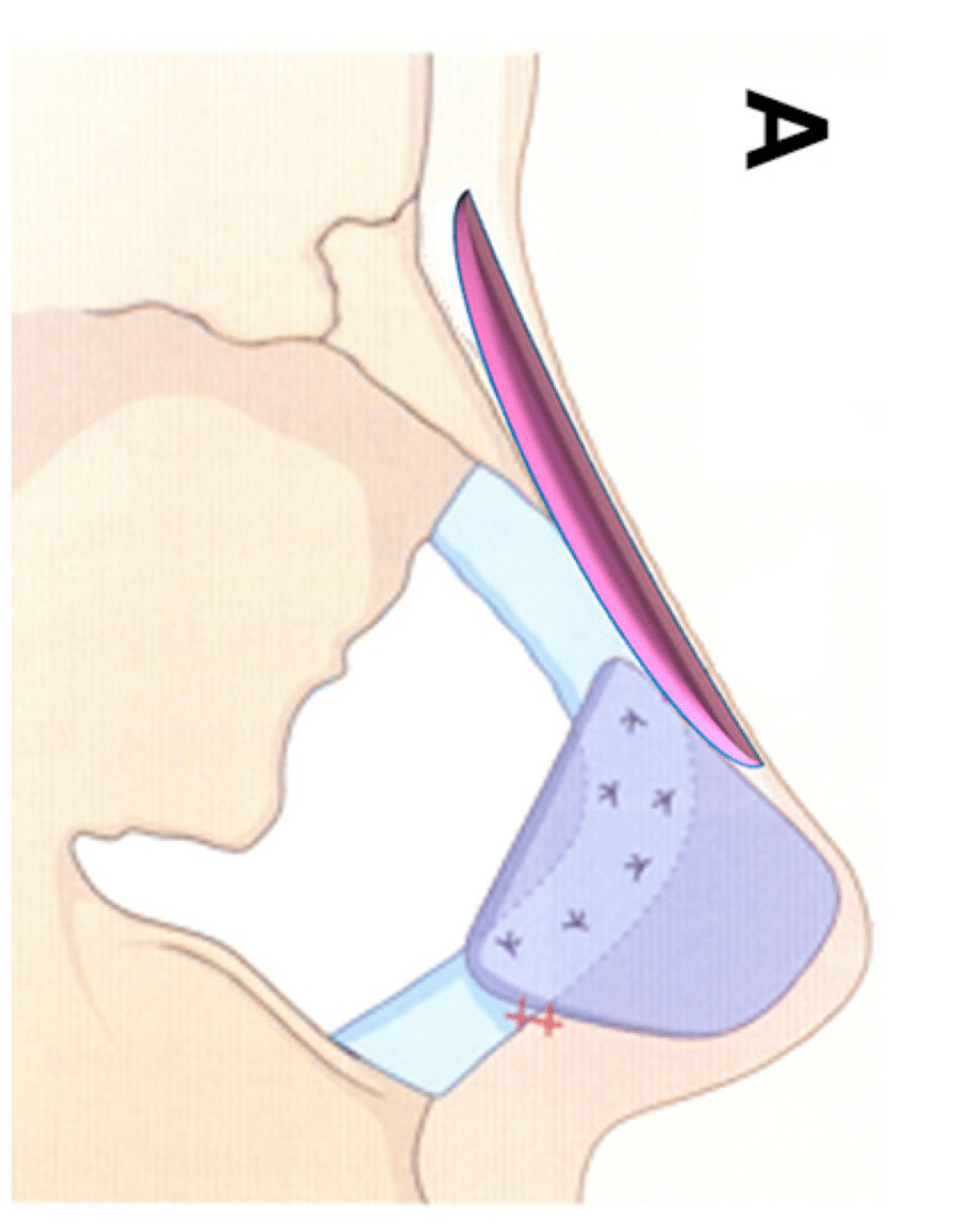 人中短縮＋鼻中隔延長の同時施術は可能か？～症例を使って解説します