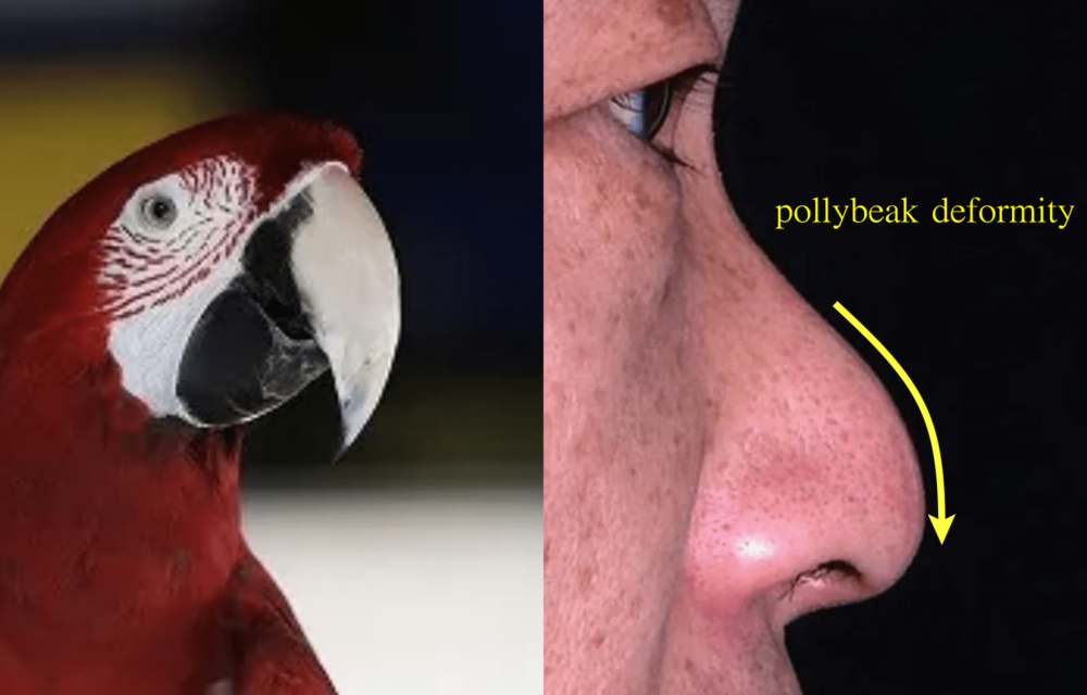 鼻のポリービーク変形って何ですか？解説します！
