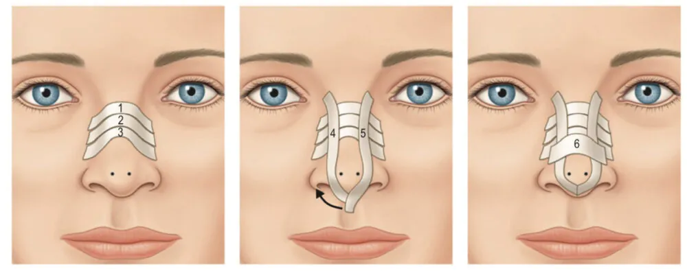 鼻整形のダウンタイムの過ごし方～①固定について