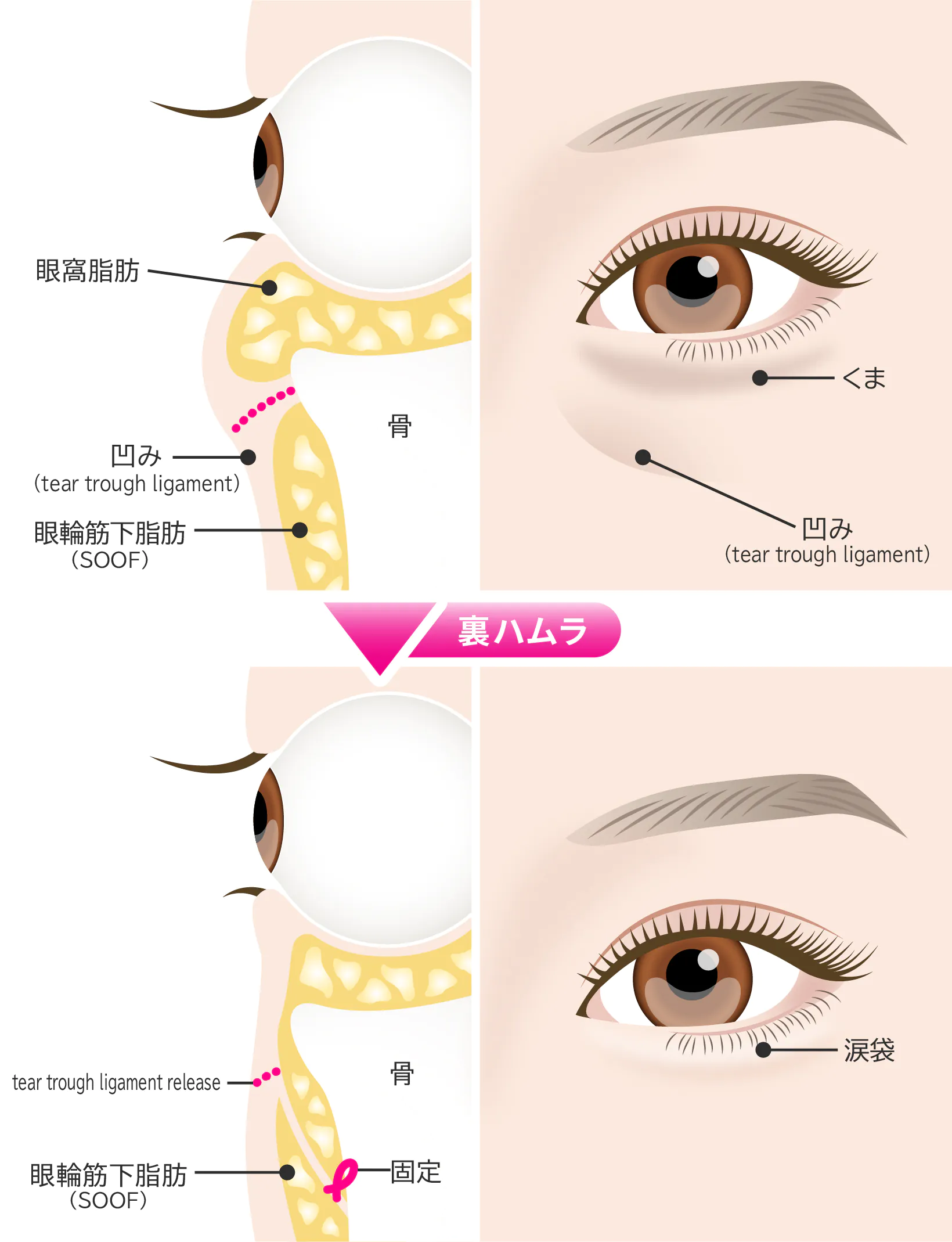裏ハムラ法とは – ハムラ法 傷跡 _ ハムラ法・裏ハムラ法とは？効果とメリット – BDYTE