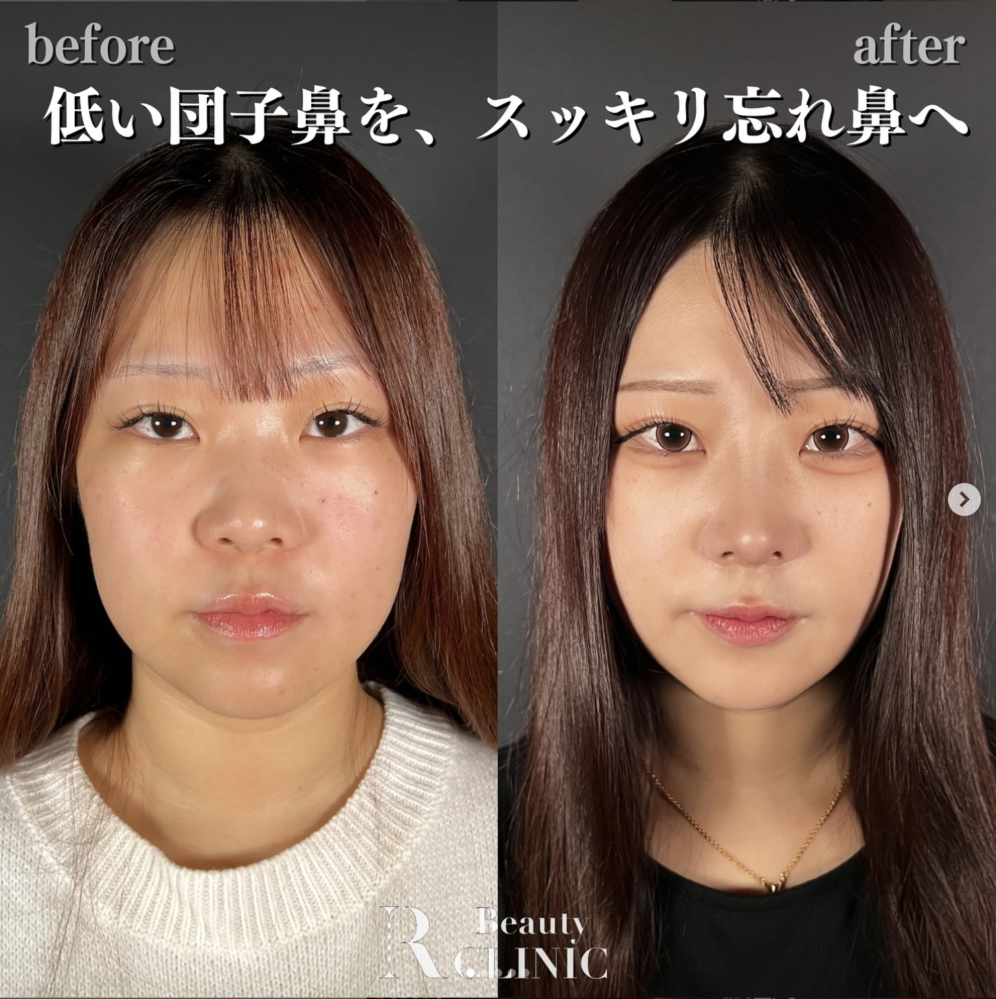 綺麗な鼻腔 自分の顔にあった鼻のデザインとは？顔の特徴による似合う鼻の見つけ方を解説 | アールビューティークリニック  銀座・名古屋・大阪｜美容整形・美容外科・美容皮膚科