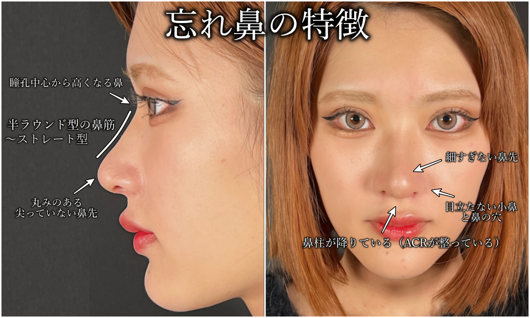 綺麗な鼻腔 自分の顔にあった鼻のデザインとは？顔の特徴による似合う鼻の見つけ方を解説 | アールビューティークリニック  銀座・名古屋・大阪｜美容整形・美容外科・美容皮膚科