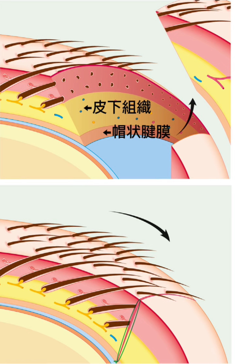 「額縮小」と「前額リフト」の違いとは？