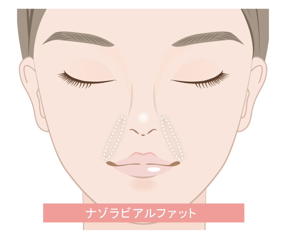 ナゾラビアルファットって何？
