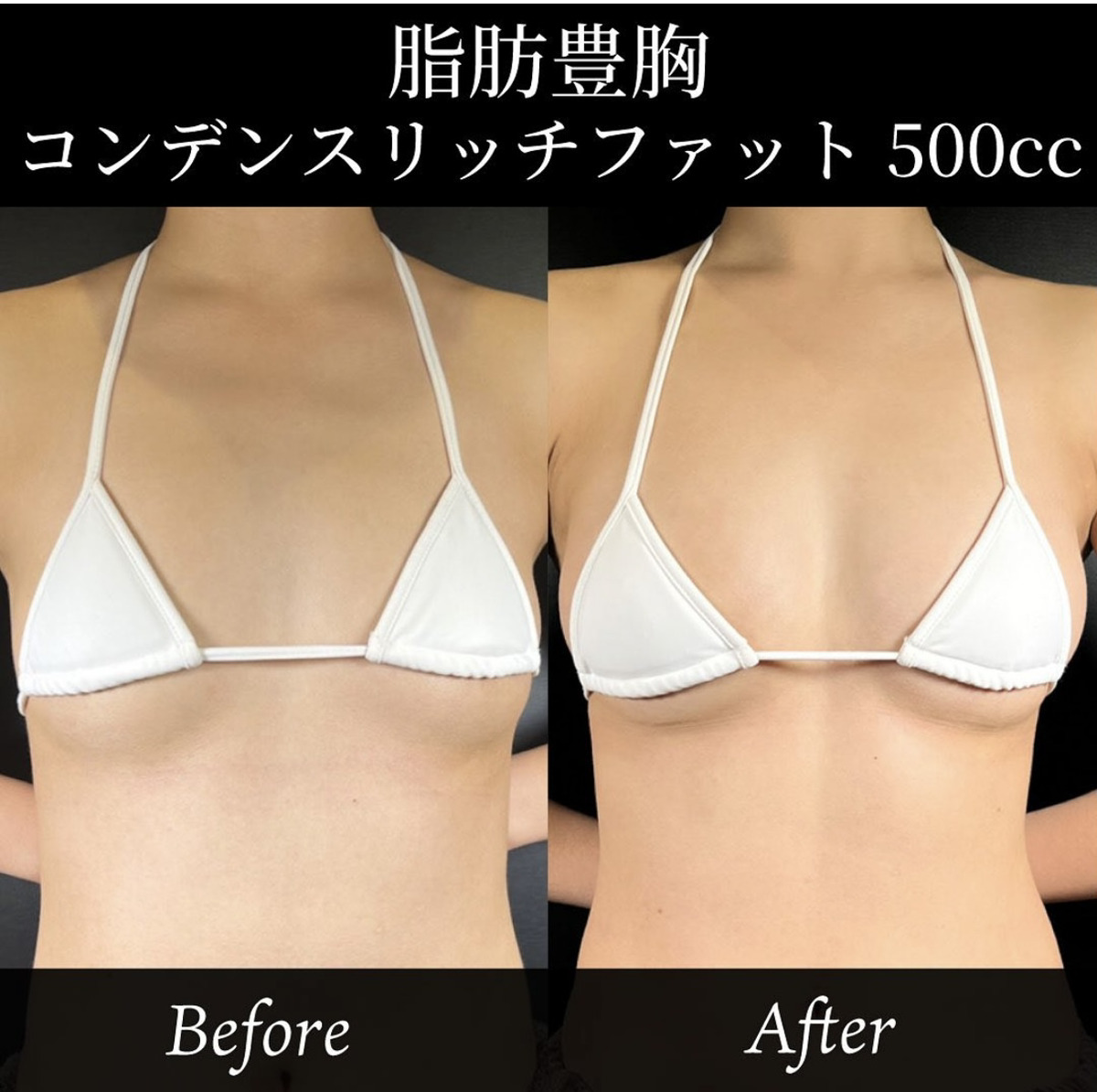 人工物に抵抗がある方におすすめ？脂肪豊胸について