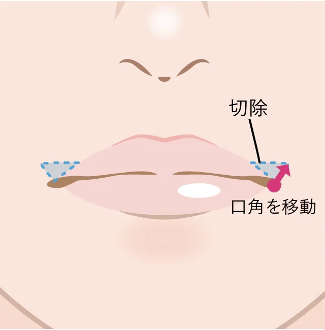 『笑っても可愛い』を叶える！韓国式口角挙上術の魅力とは？