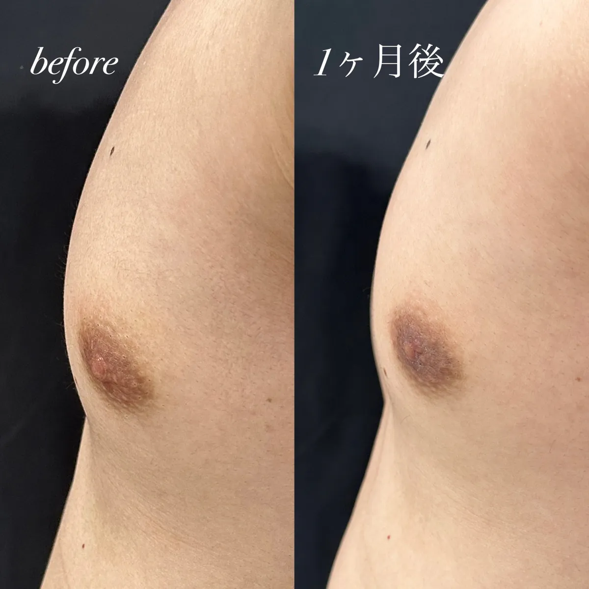 男性でも乳首の悩みはある！！？