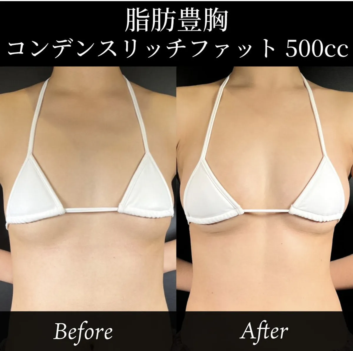 人工物に抵抗がある方におすすめ？脂肪豊胸について