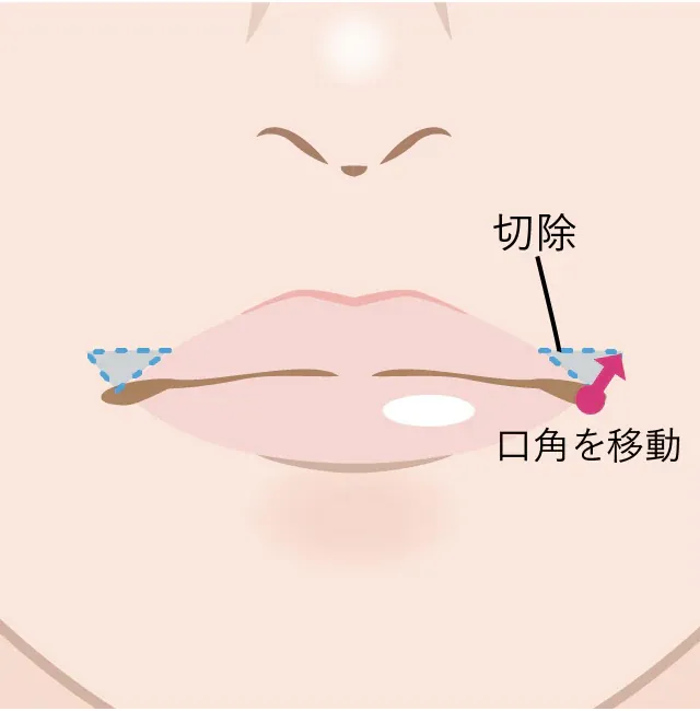 『笑っても可愛い』を叶える！韓国式口角挙上術の魅力とは？