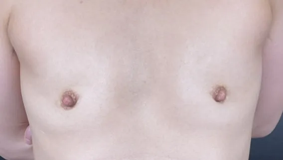乳頭縮小術後一ヶ月後の変化は？
