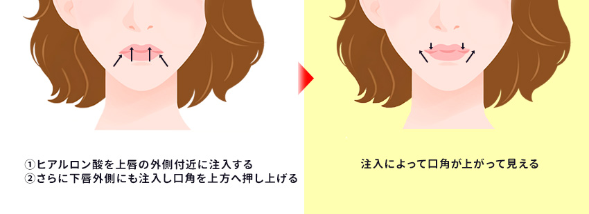 口角挙上_ヒアルロン酸