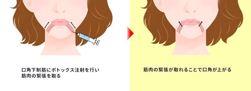 口角挙上は後悔する？　失敗しない対策とは