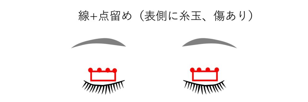 二重埋没法「挙筋法」と「瞼板法」の違いとは？「線留め」と「点留め」の違いは？