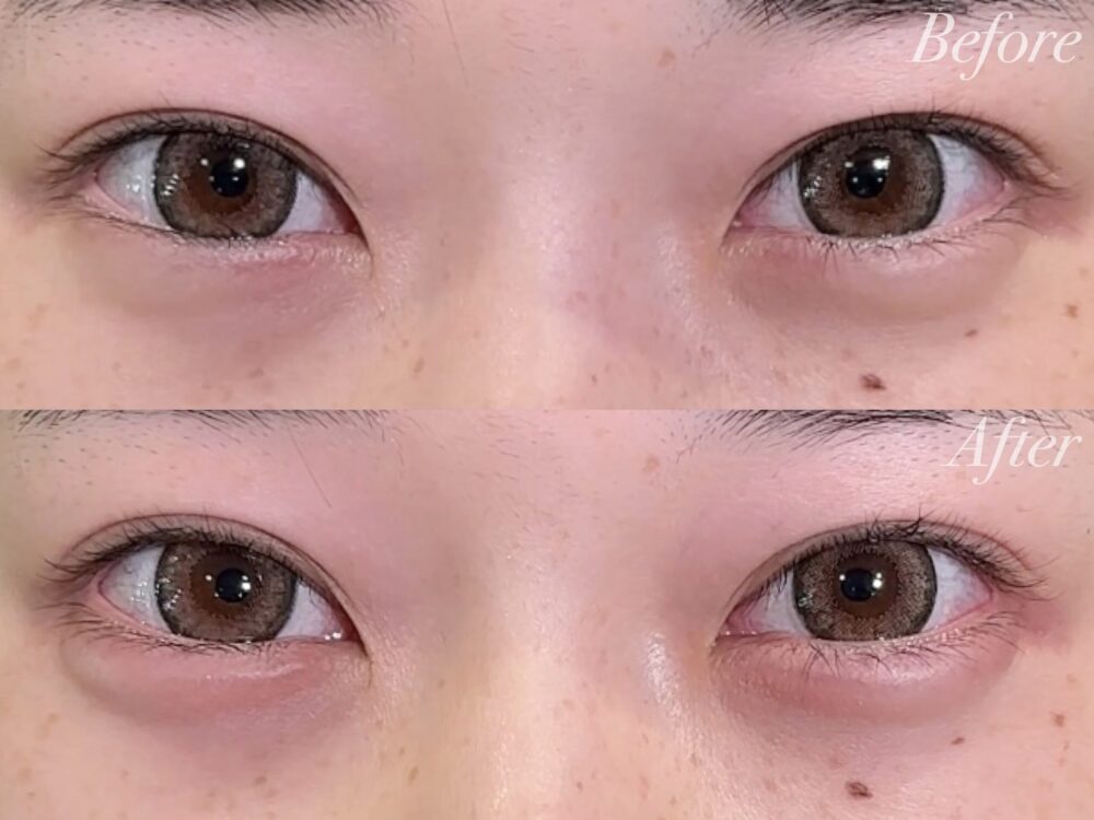 二重埋没のダウンタイムって？(他院で1度、埋没経験のある患者さまの経過)