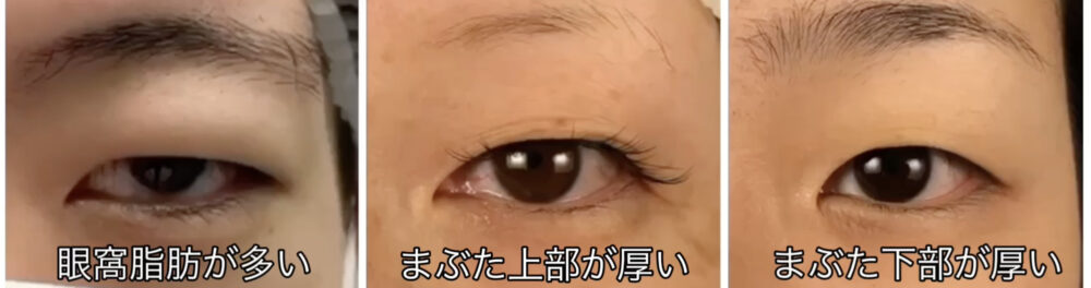 まぶたが分厚い人は必見！！まぶたの脂肪取りの効果とは？医師が解説！