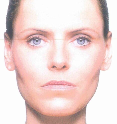 口角を上げると印象が変わる！？（当院で行う口角挙上術について）