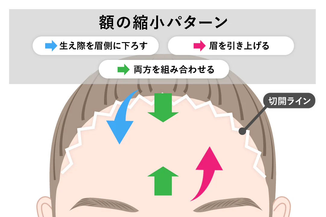 額縮小：エキスパンダー法について