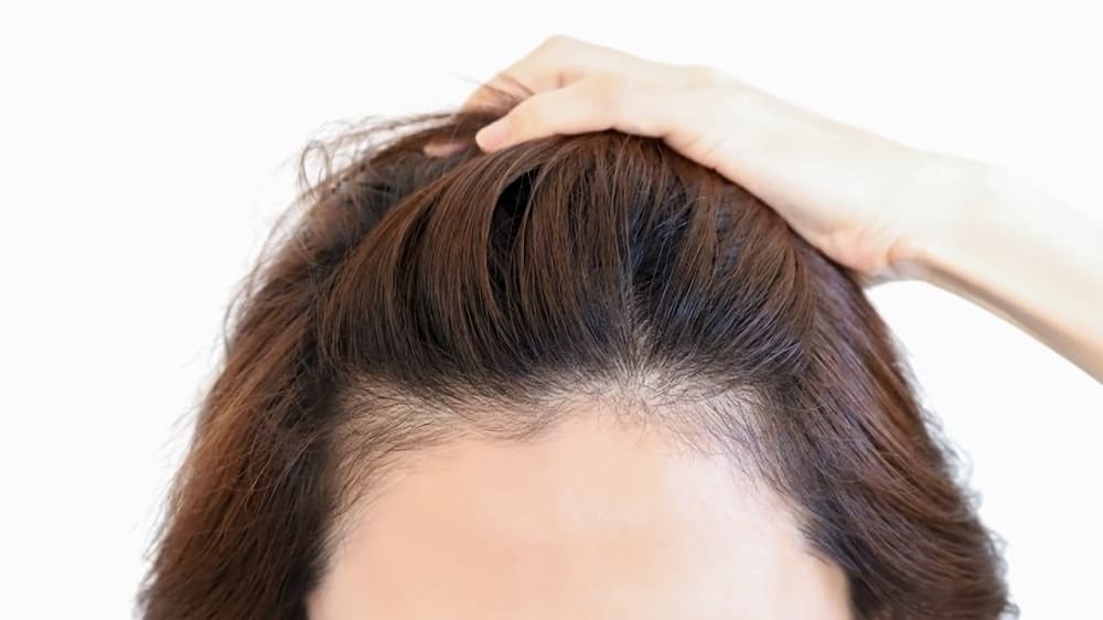 生え際がM字なのは生まれつき？薄毛？おでこが薄い原因の判断ポイントや男性・女性の治療方法を解説