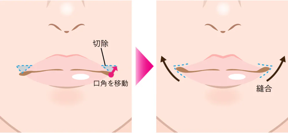 口角挙上術のダウンタイムはどのくらい？