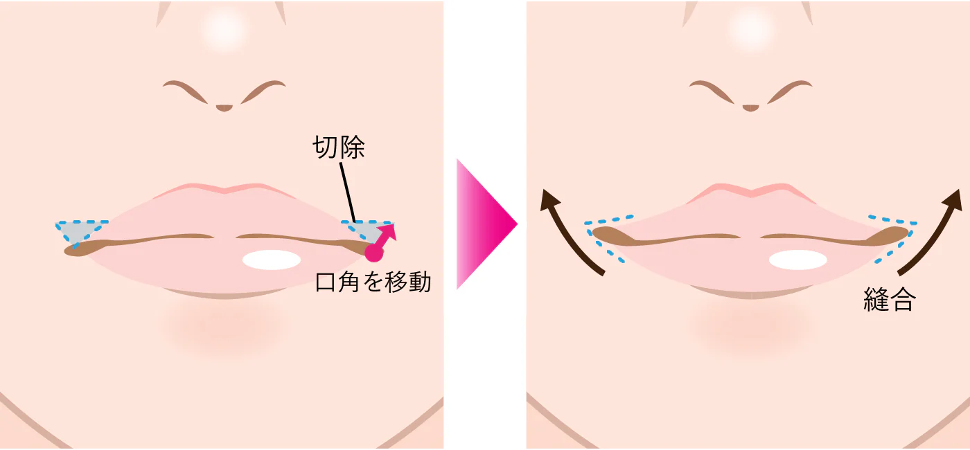 口唇整形のダウンタイムはどのくらい？