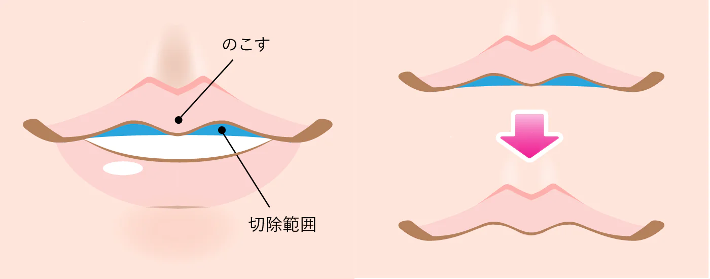 M字リップ形成術とは