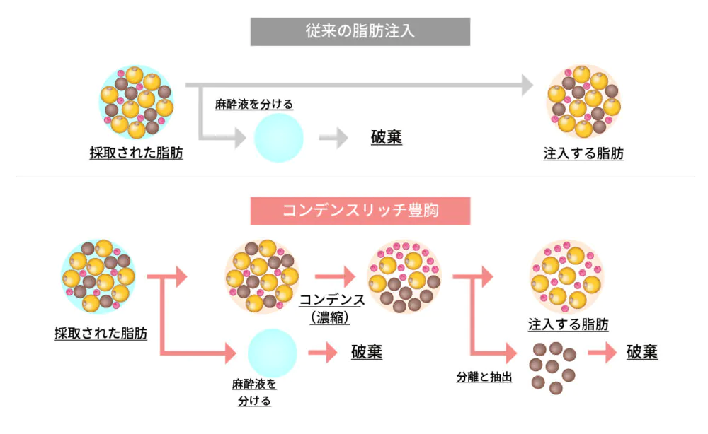 コンデンスリッチ豊胸