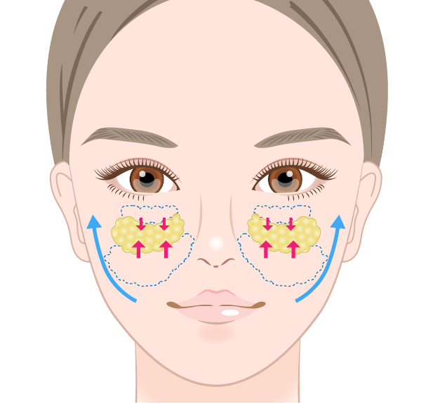 ミッドフェイスリフト