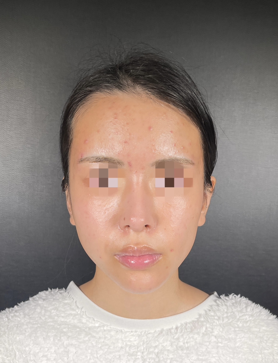 額縮小術後の傷痕経過―時間とともにどのように変化するのか