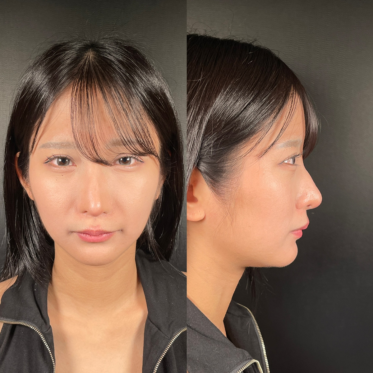 20代女性に対するフェイスリフト症例―口元のもたつきに対する根本治療