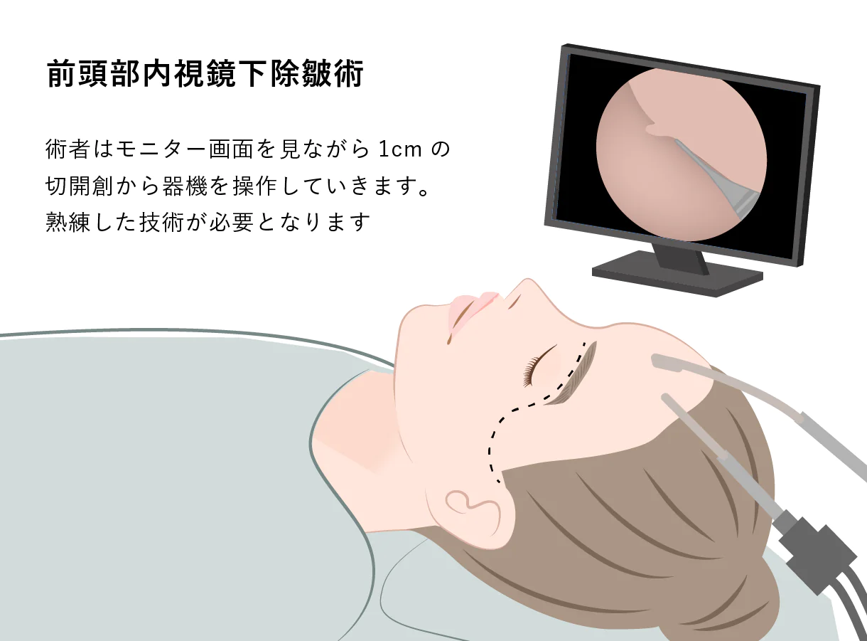 若さは上顔面から！内視鏡前額リフトとは？―適応・ダウンタイム・リスクまでわかりやすく解説