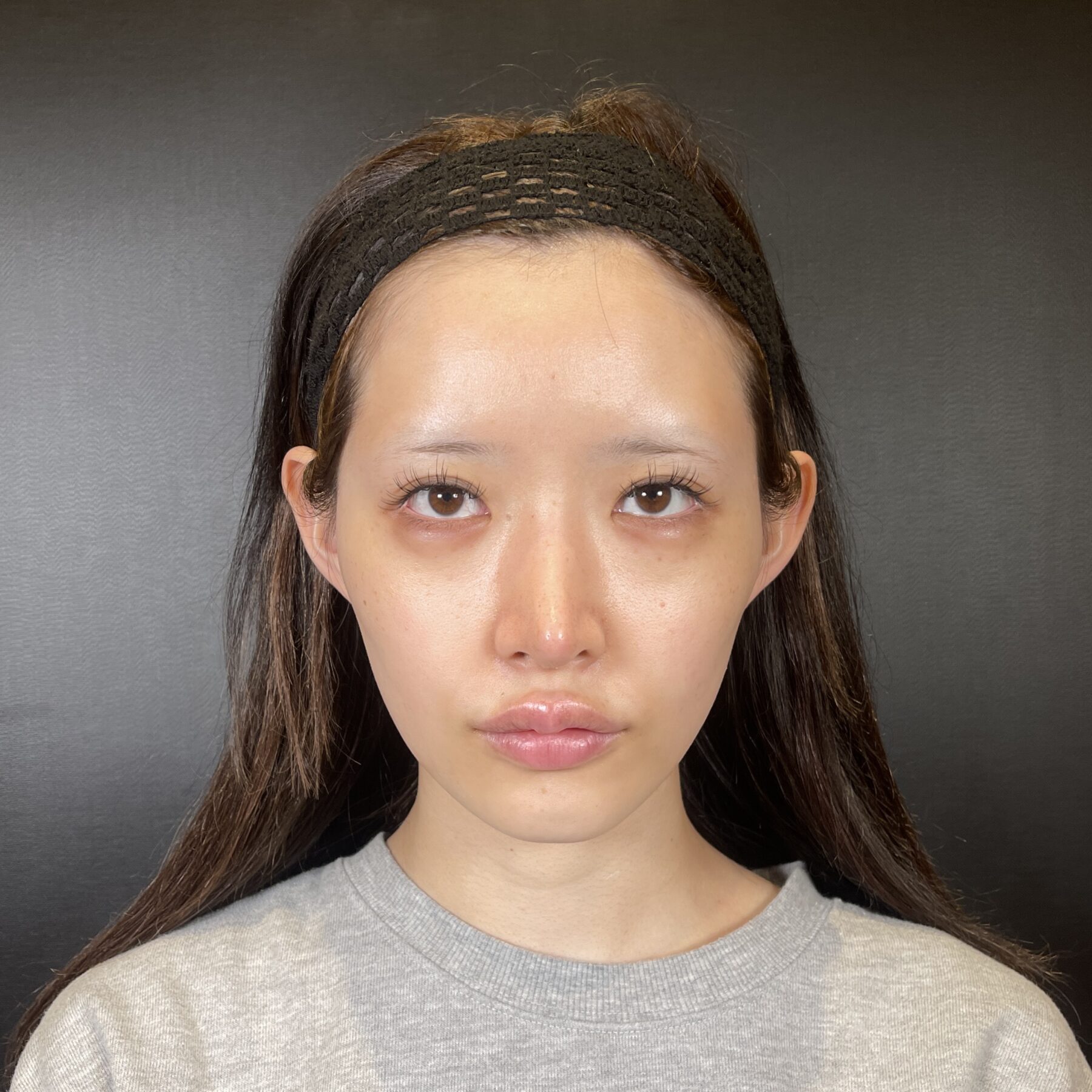 術前