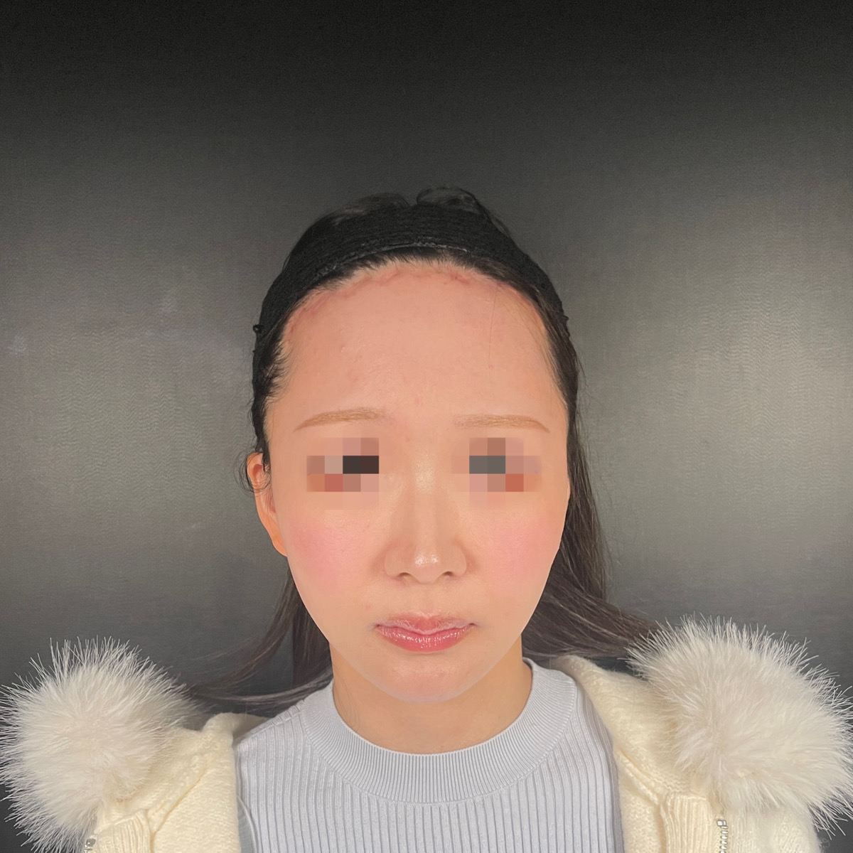 術前