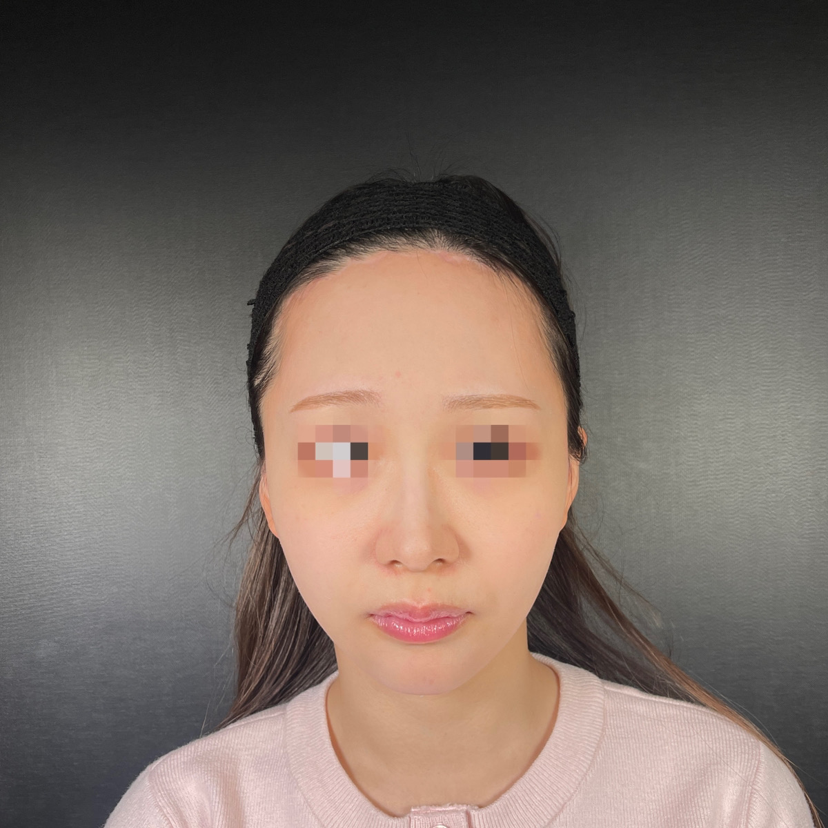 術前