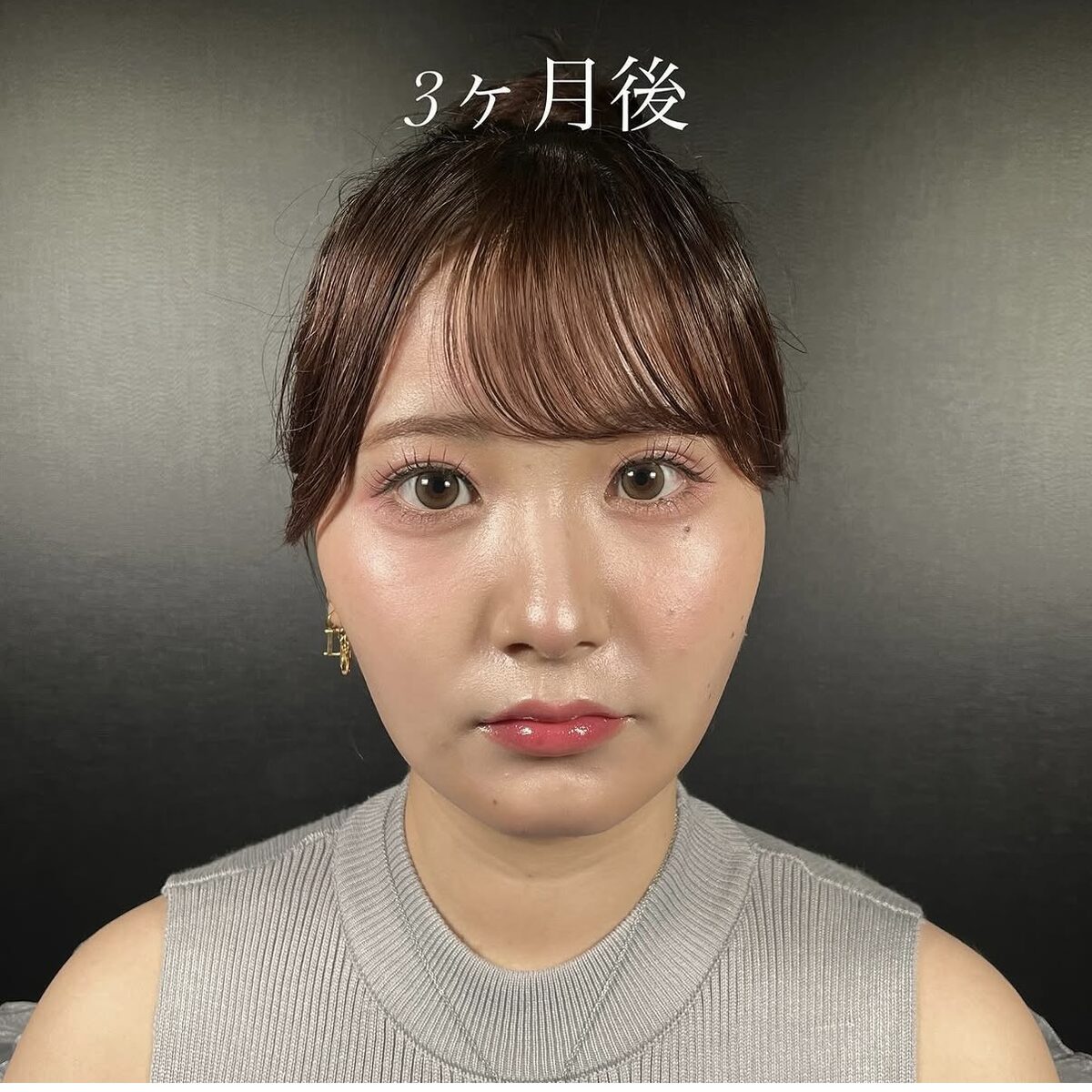 術後