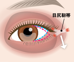 目尻靱帯移動（目尻の位置・角度調整）