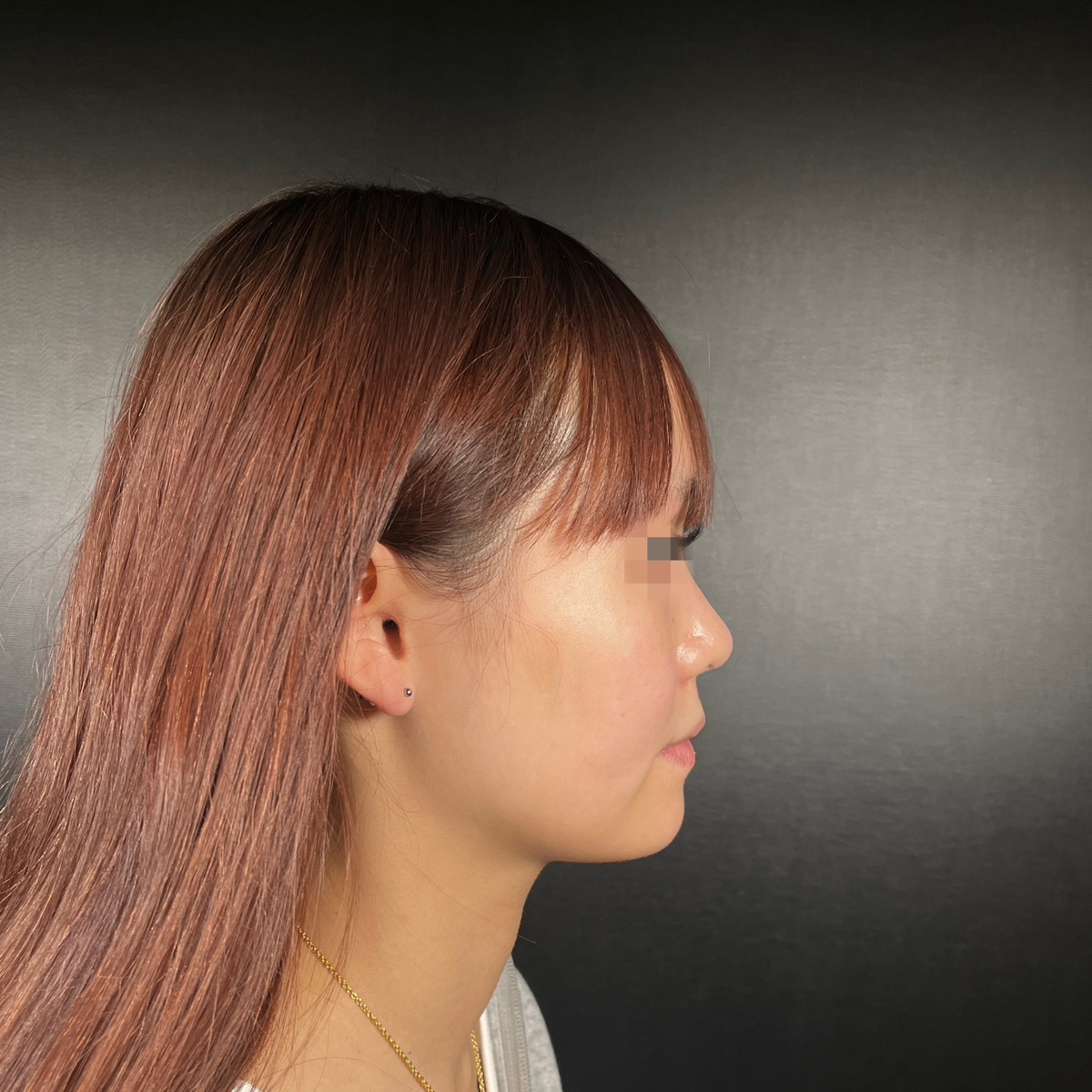 中顔面陥没を改善することで美人度劇的改善！