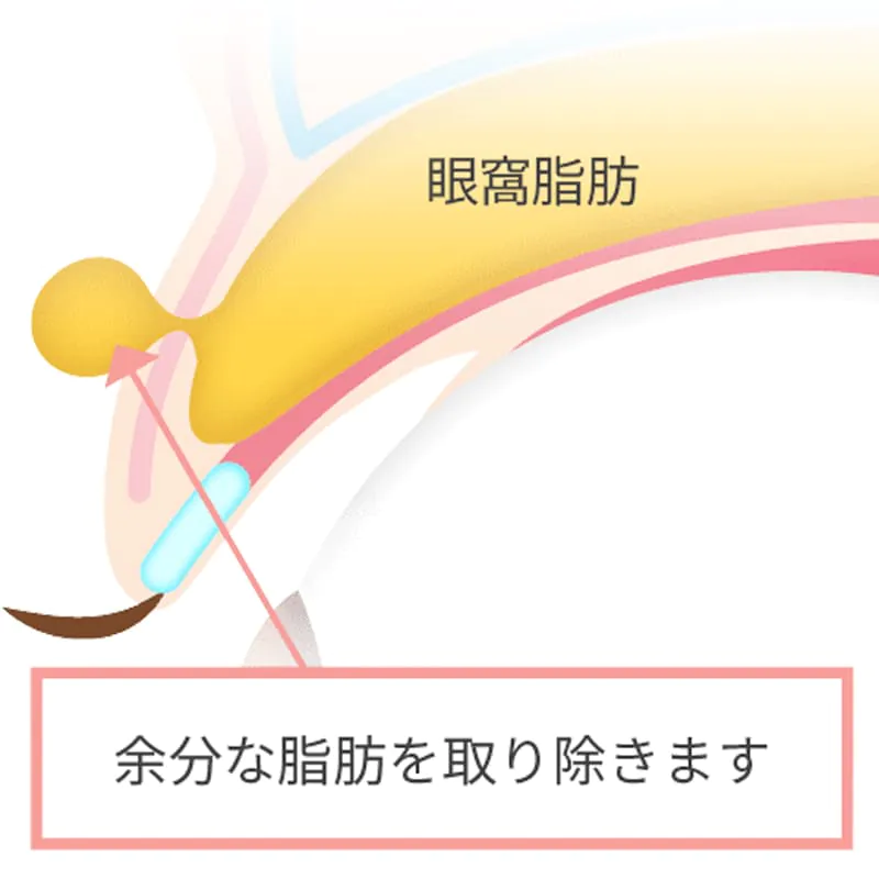 まぶたの脂肪取り
