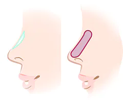適切なプロテーゼ挿入
