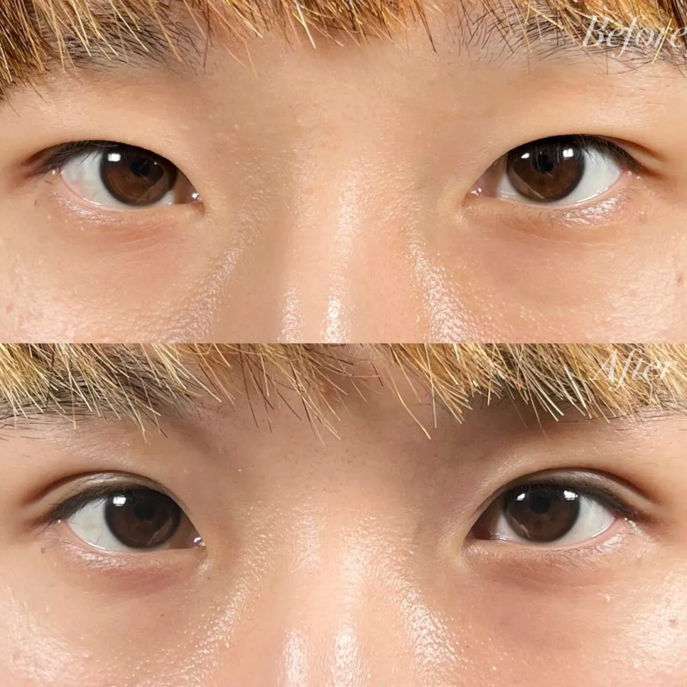 男性に似合う二重埋没って？？