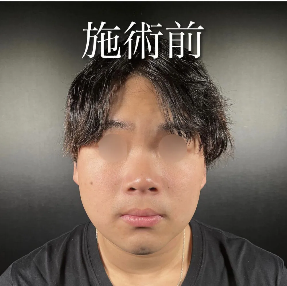 男性の顔たるみ対策