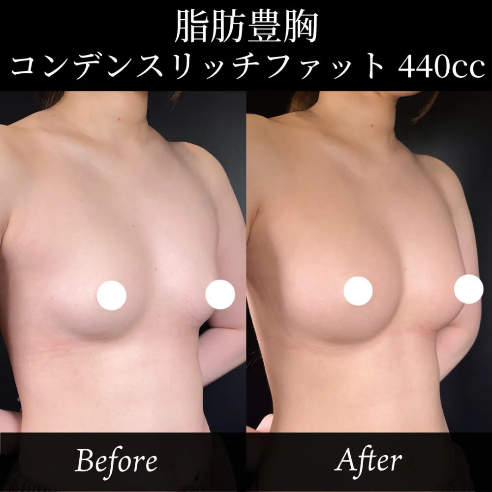 脂肪豊胸でバストアップ