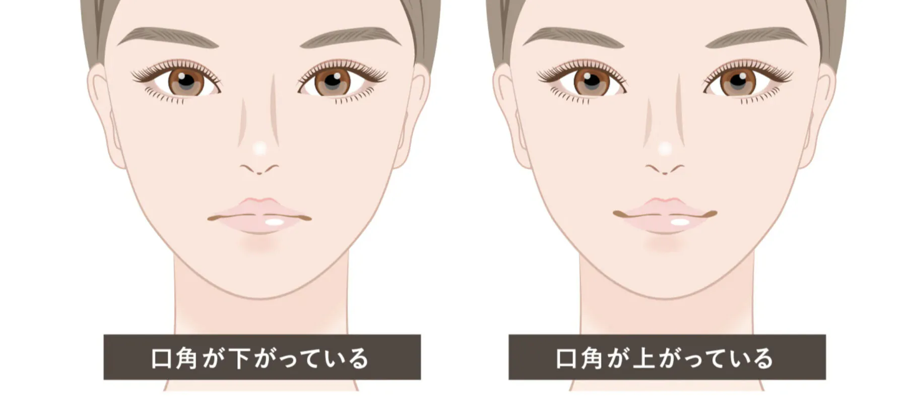 口角挙上、唇整形で失敗?ジョーカーにならない唇整形を解説!