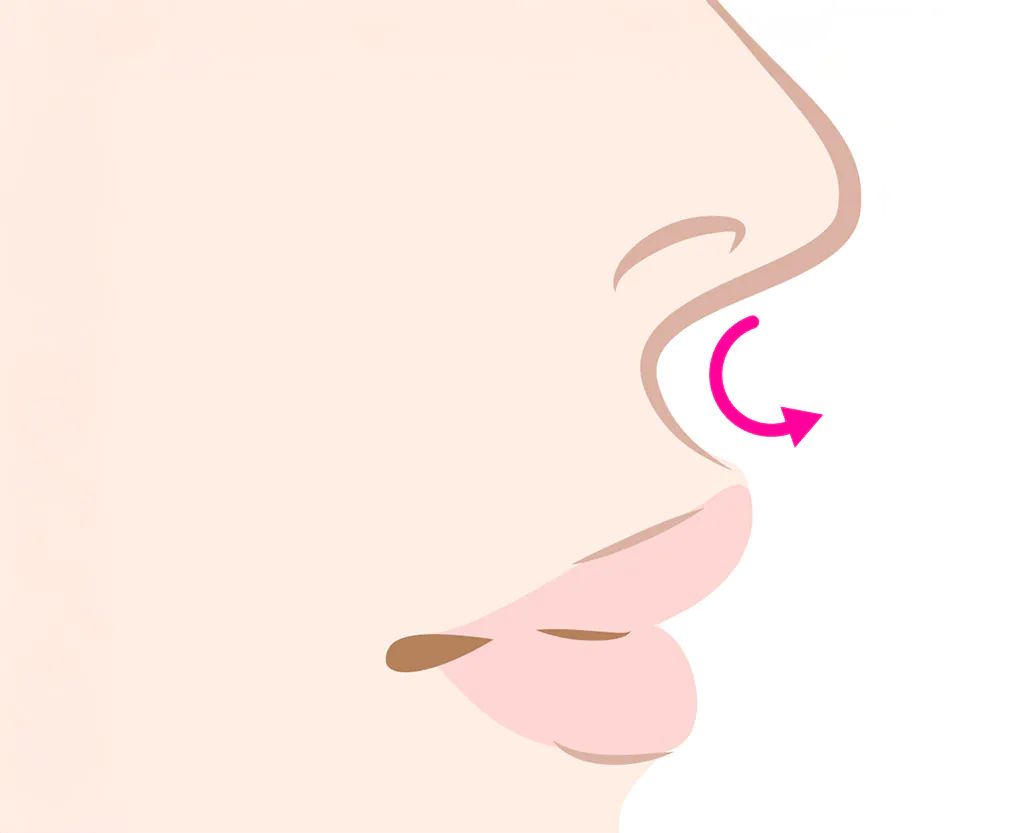 Cカールリップ形成術