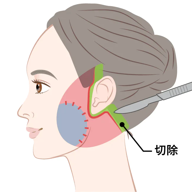 フェイスリフト・ネックリフト | アールビューティークリニック 銀座