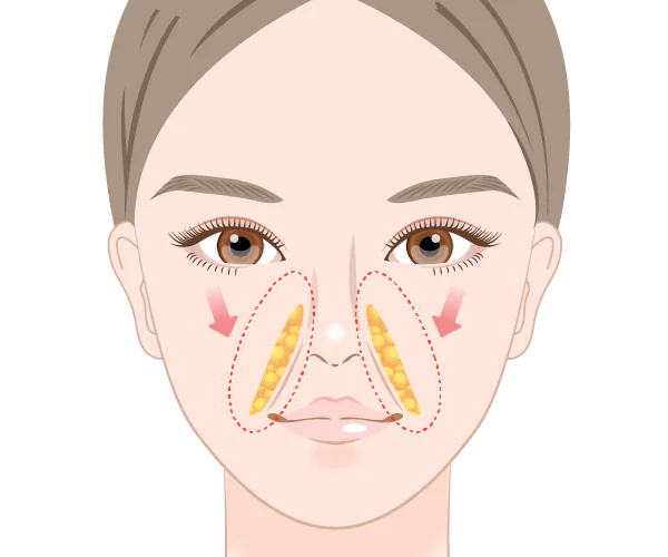 ナゾラビアルファット除去