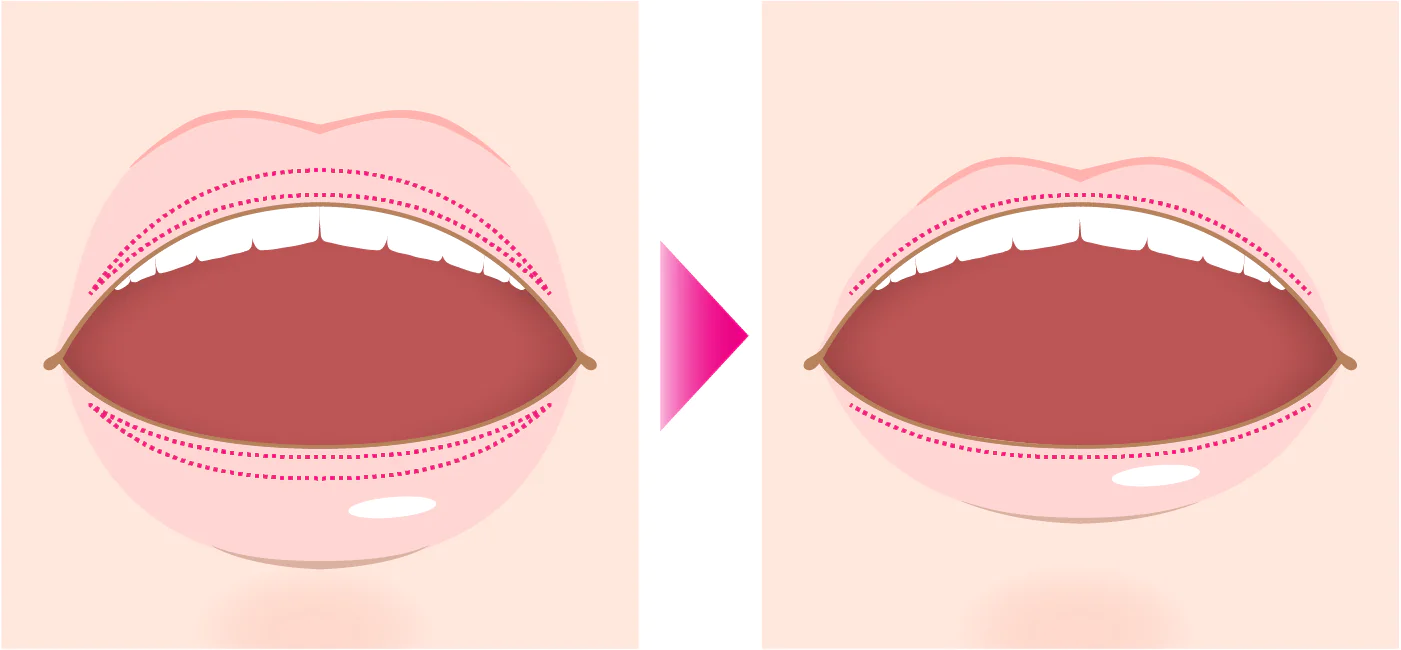口唇縮小