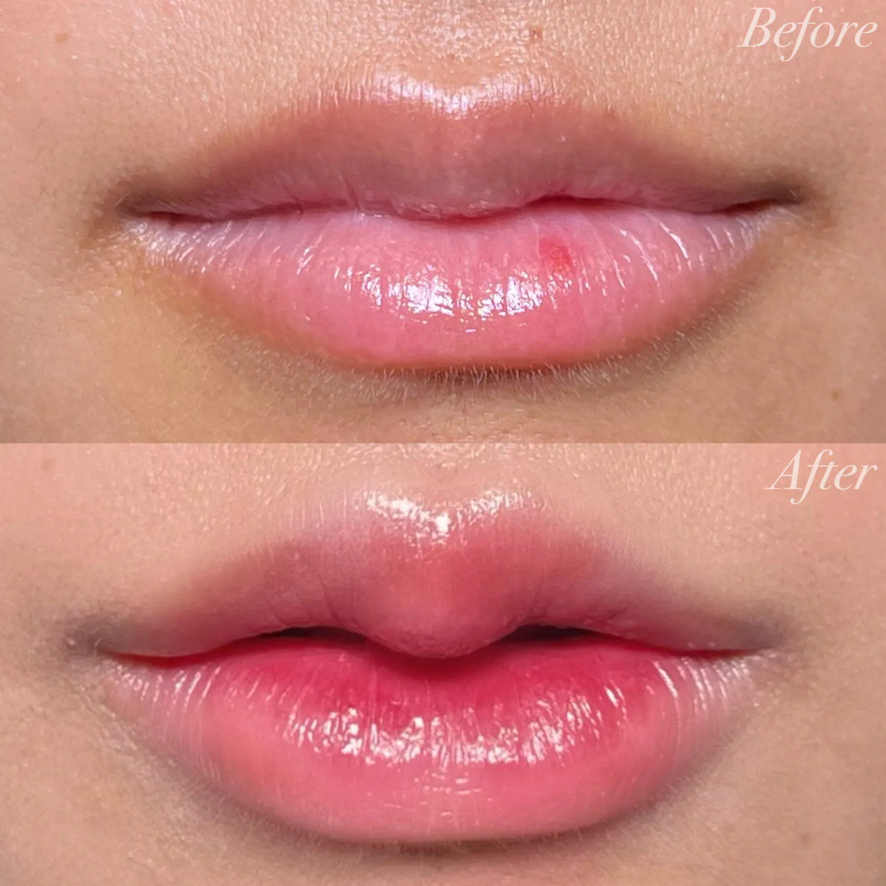 M字リップヒアルロン酸症例