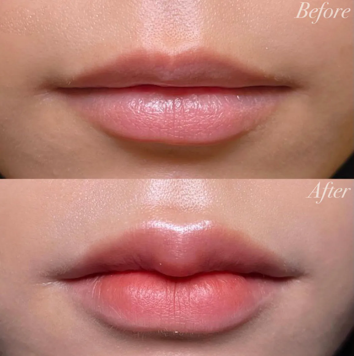 M字リップヒアルロン酸症例