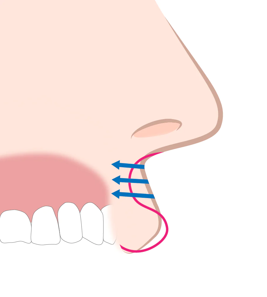Cカールリップ形成術